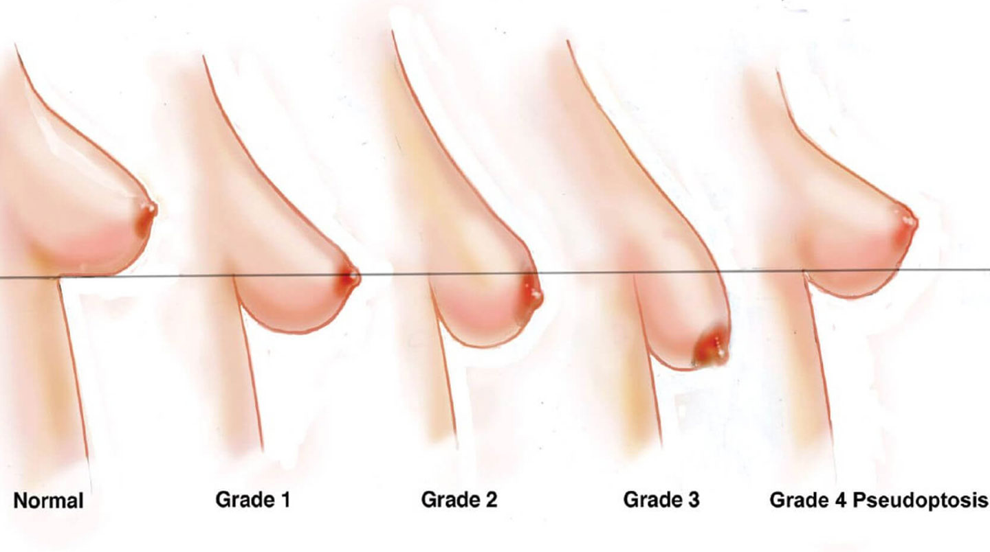 Schéma médical classification ptôse mammaire en 3 grades : ptôse légère (mamelon au niveau sillon), modérée (mamelon sous sillon) et sévère (mamelon orienté vers bas)